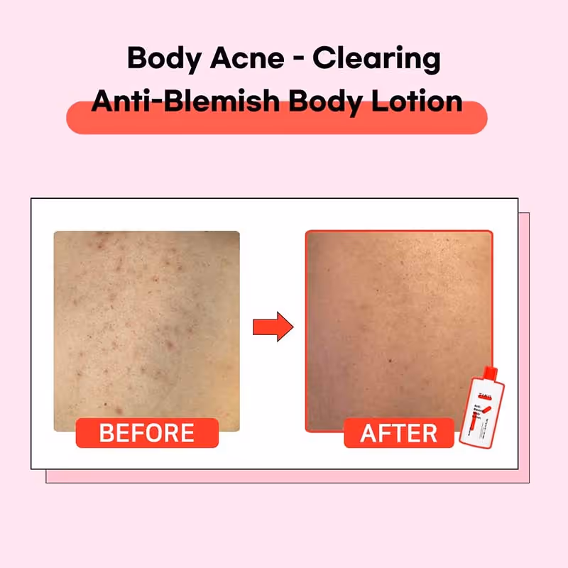 لوسیون ضدجوش بدن تیام tiam anti blemish