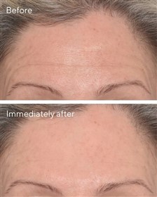 کرم پر کننده خطوط دکتر مورد Murad Targeted Wrinkle Corrector حجم 15 میلی لیتر